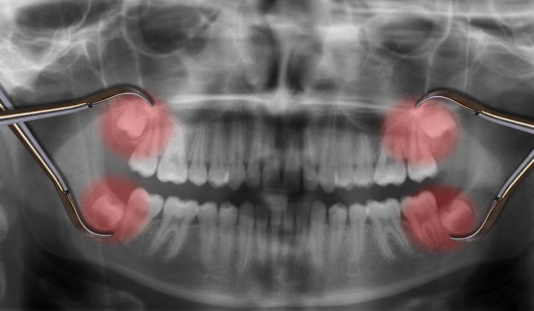 emergency-wisdom-teeth-removal-1080x630
