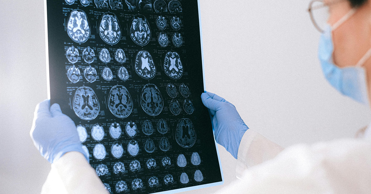 gum-disease-cause-dementia